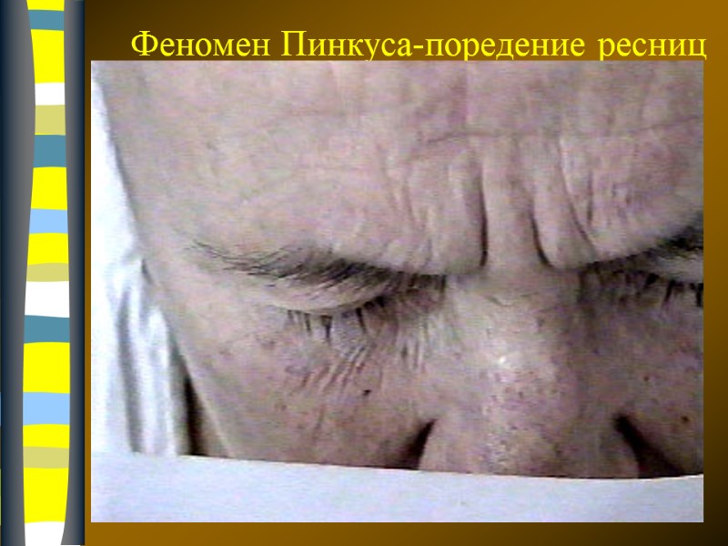 09.12.2017 Феномен Пинкуса-поредение ресниц